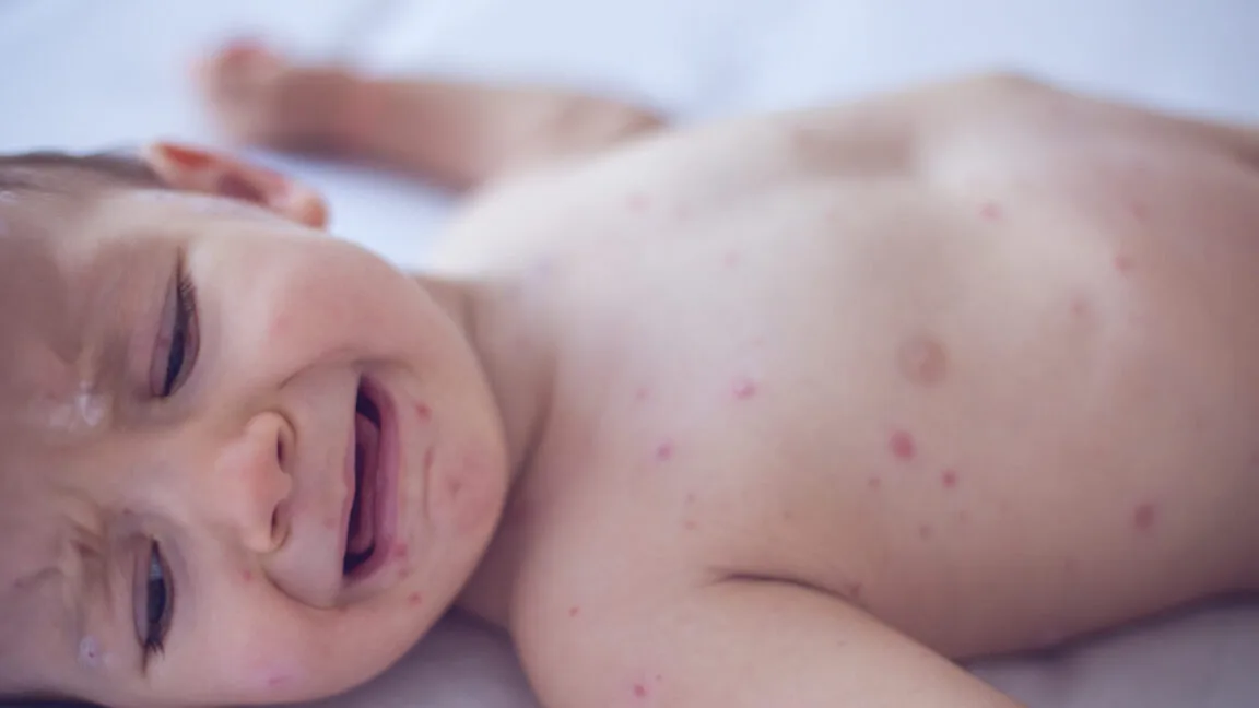 Collapsing US herd immunity to measles spurs experts to call for extra MMR dose