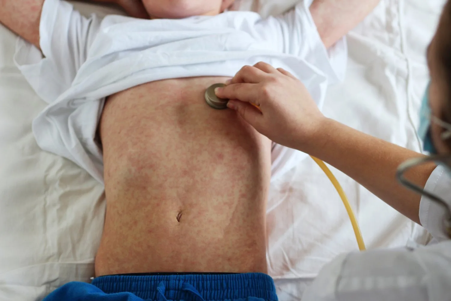 Eye-Popping WHO Report Shows Measles Surging Across the Globe